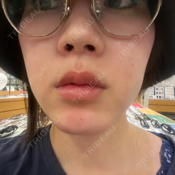 医療脱毛（顔） 共立美容外科 立川院 BEFORE メイン用