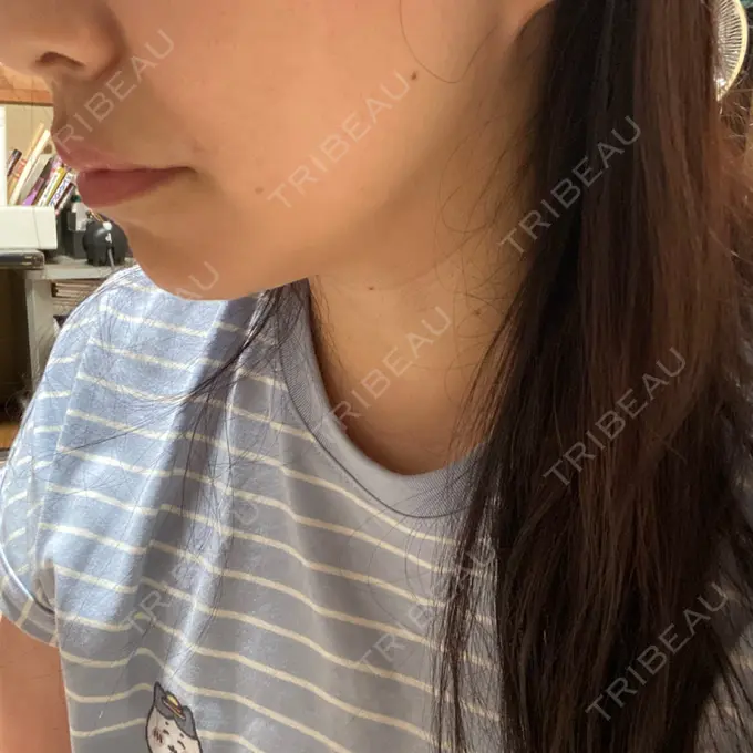 その他（輪郭） ルラ美容クリニック 渋谷本院 BEFORE メイン用