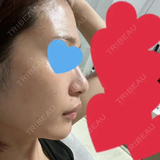軟骨移植 / 眉間プロテーゼ / 鼻尖縮小 / ヒアルロン酸注入（鼻翼基部） 東京シンデレラ美容外科 新宿院 BEFORE メイン用