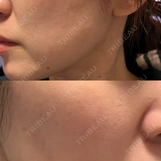 フラクショナルレーザー（毛穴・ニキビ跡） Designo Clinic （デジーノクリニック） BEFORE メイン用