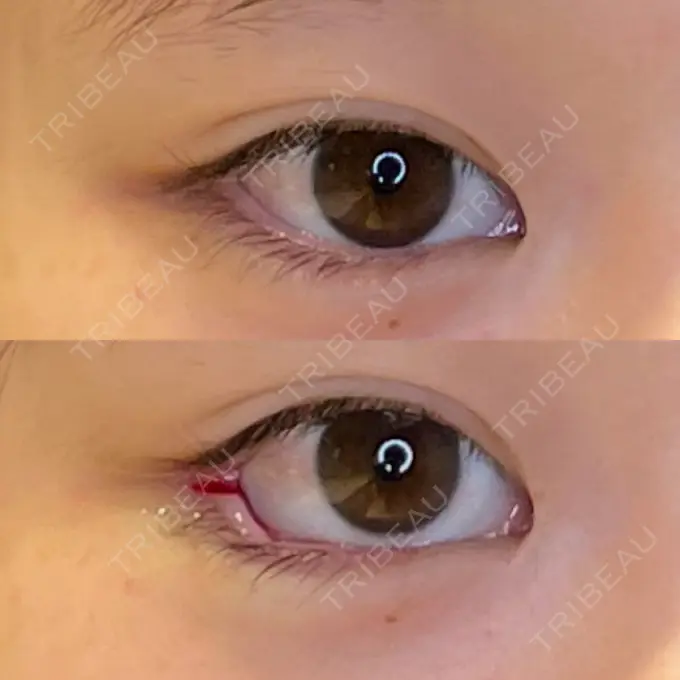 目尻切開 / タレ目形成・グラマラスライン（埋没） LOUIS CLINIC 二子玉川院【ルイクリニック】 BEFORE メイン用