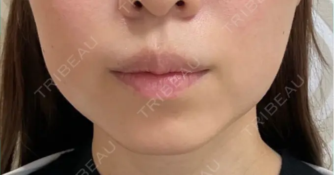 糸リフト / バッカルファット除去 / ヒアルロン酸注入（あご） 大阪TAクリニック BEFORE メイン用