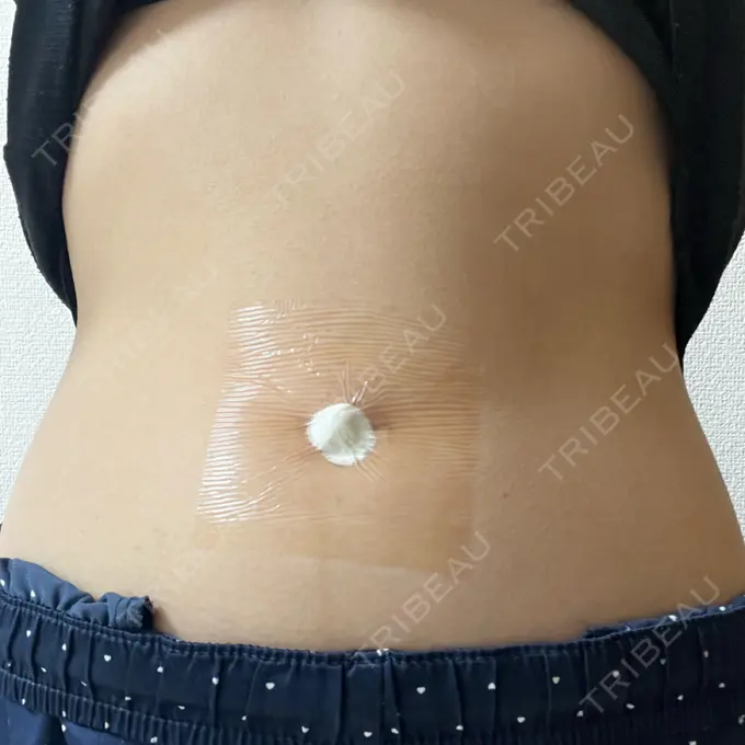 へそ形成 藤・ナチュレ美容クリニック 銀座院 BEFORE メイン用