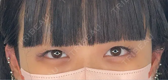 二重埋没 / ヒアルロン酸注入（涙袋） アリエル美容クリニック 横浜院 BEFORE メイン用