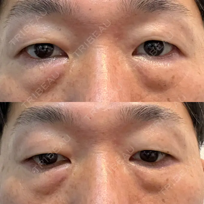 クマ治療 / 下まぶたの脂肪取り ROOTS Clinic BEFORE メイン用