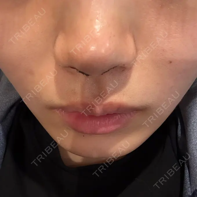 鼻尖形成（切開） ネビュラクリニック 京都院 BEFORE メイン用