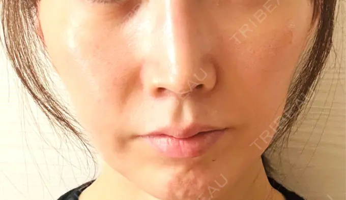 肌育注射（ジュベルックなど） / その他（肌） ゆきスキンクリニック 東池袋 BEFORE メイン用