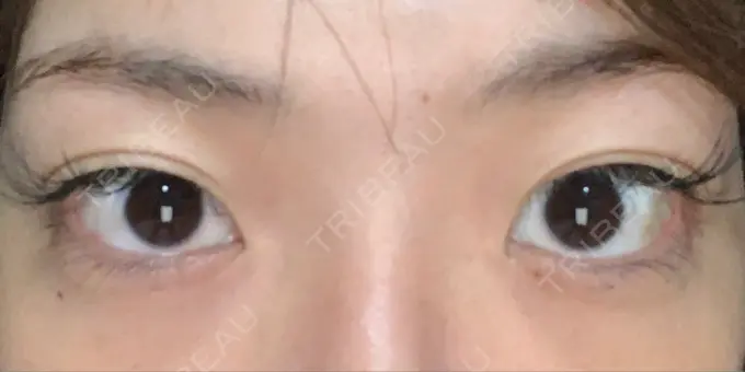 二重切開 / 目頭切開 城本クリニック 福岡院 BEFORE メイン用