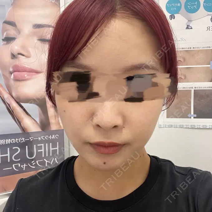 ボトックス（エラ・小顔） LIBER CLINIC BEFORE メイン用