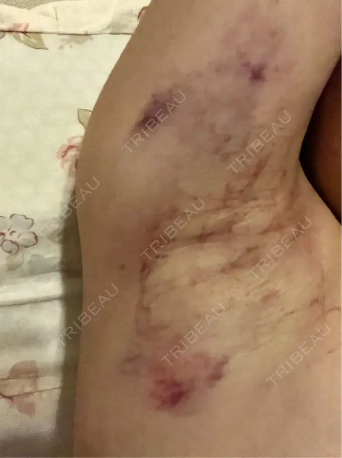 ワキ汗治療（レーザー） ルラ美容クリニック 渋谷本院 BEFORE メイン用