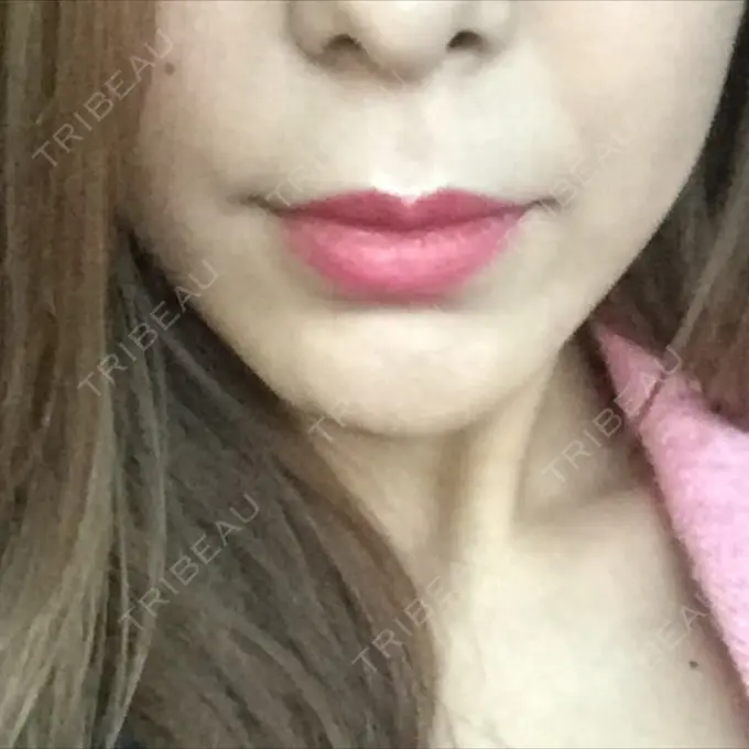 人中短縮 グリム整形外科 BEFORE メイン用