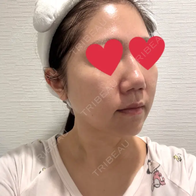 隆鼻術 / 鼻中隔延長（切開） / 軟骨移植 / 骨切幅寄せ / 斜鼻修正 / 鼻孔縁挙上 / 鼻尖縮小 / 鼻翼基部形成（貴族手術） / 鼻柱下降・鼻唇角形成（猫手術） WOM CLINIC GINZA （ワム クリニック ギンザ） BEFORE メイン用