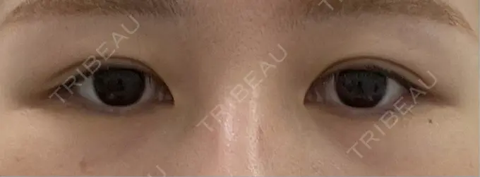 二重埋没 R Beauty CLINIC 銀座院 BEFORE メイン用