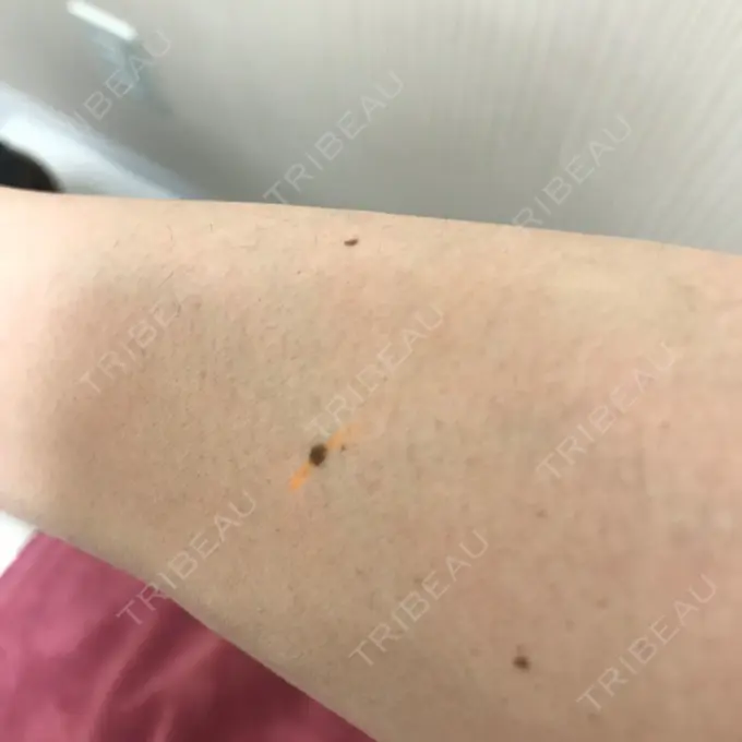 ほくろ・いぼ切除（肌） やさしい美容皮膚科・皮フ科　秋葉原院 BEFORE メイン用