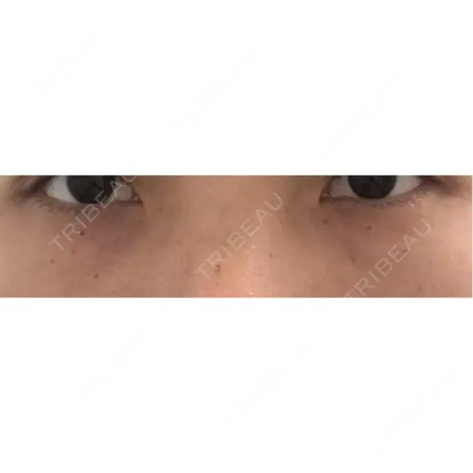 下まぶたたるみ取り 東京形成美容外科 船橋院 BEFORE メイン用