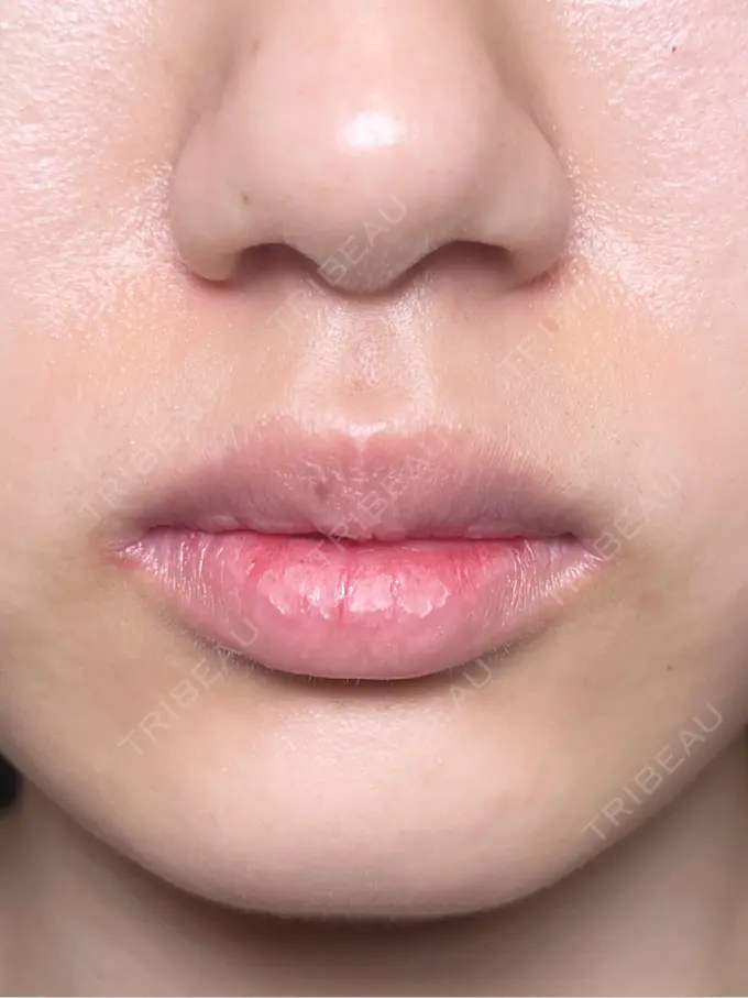 口角挙上 / その他（口元） R Beauty CLINIC 銀座院 BEFORE メイン用