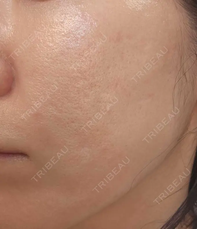 肌育注射（ジュベルックなど） L‘amour clinic Tokyo【ラムールクリニック東京】 BEFORE メイン用