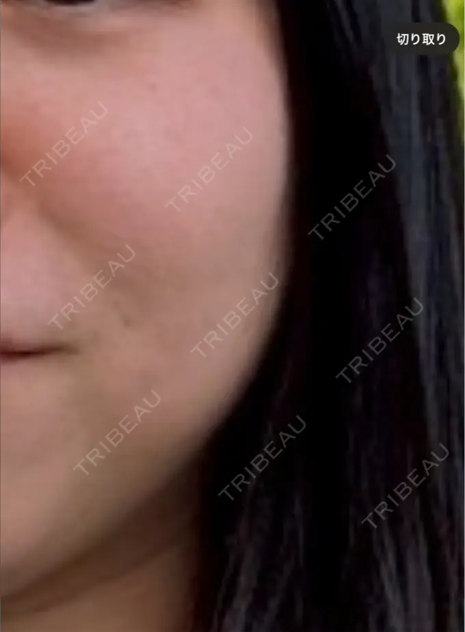 ルメッカ 大美会クリニック 心斎橋本院 BEFORE メイン用