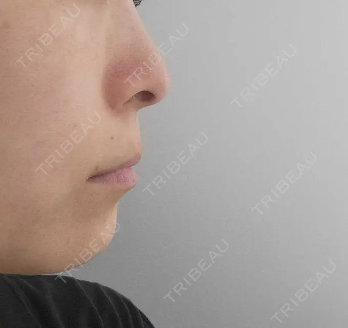 人中短縮 / 鼻孔縁下降 / 口角挙上 新宿ラクル美容外科クリニック 新宿院 BEFORE メイン用