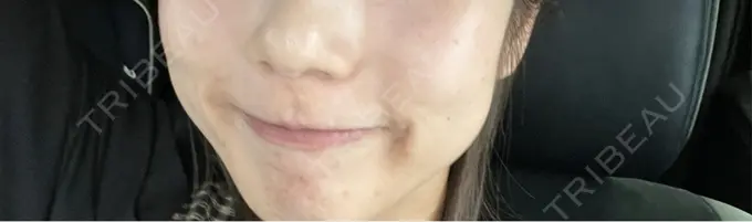 水光注射（ハリ・美肌） しんゆり美容健康クリニック BEFORE メイン用