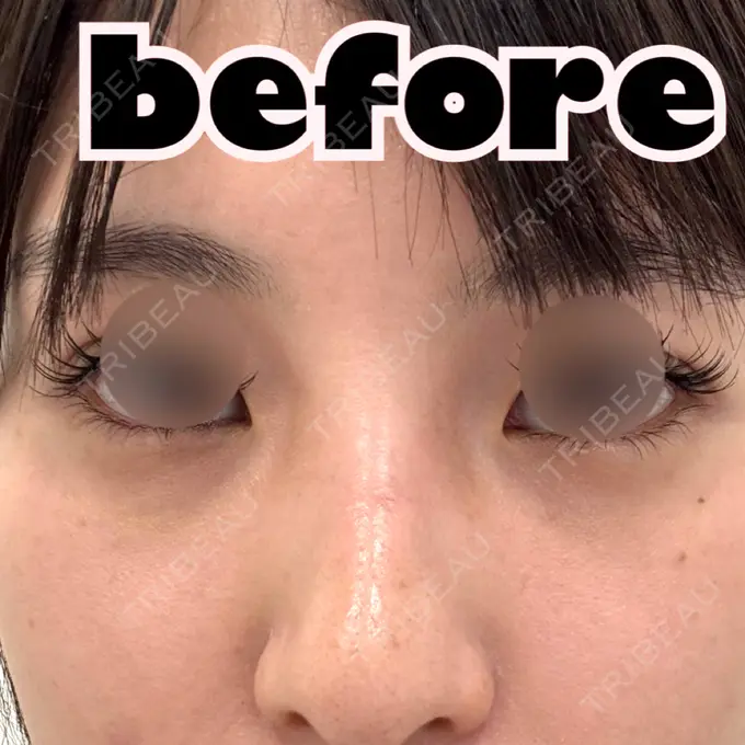 ヒアルロン酸注入（涙袋） / ヒアルロン酸注入（鼻） NARU Beauty Clinic 【ナルクリ】 水戸院 BEFORE メイン用