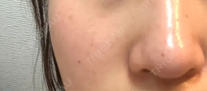 ルメッカ Grias clinic （ジリアスクリニック） BEFORE メイン用