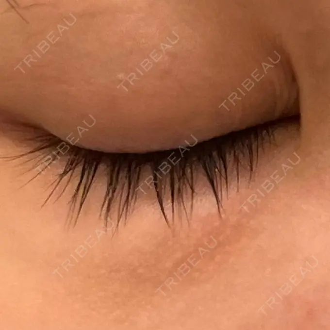 美肌レーザー まゆりなclinic 名古屋栄 BEFORE メイン用