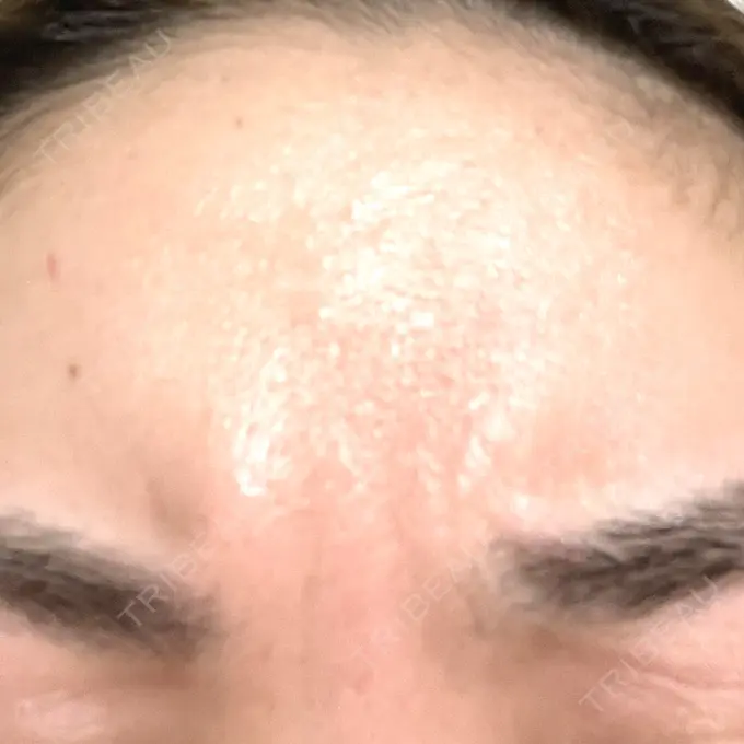 ボトックス（あご） / マイクロボトックス / ボトックス（眉間） / ボトックス（首） / ボトックス（ガミースマイル） M'sクリニック【エムズクリニック】 BEFORE メイン用