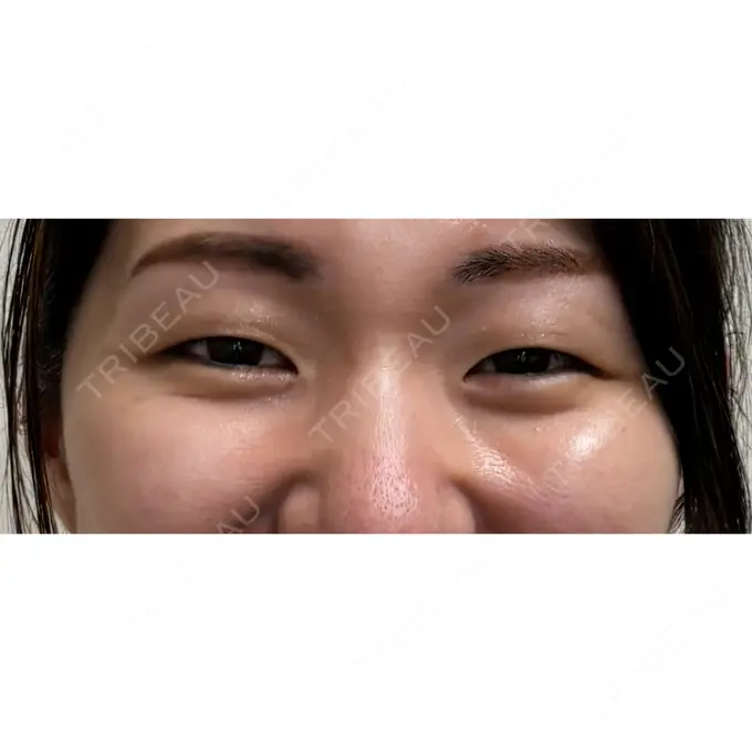 二重埋没 / 自然癒着法 ルラ美容クリニック 福岡本院 BEFORE メイン用