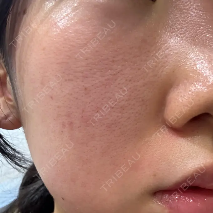 ピーリング（ニキビ・毛穴） / ピコフラクショナルレーザー（毛穴・ニキビ跡） 名駅なぎクリニック BEFORE メイン用