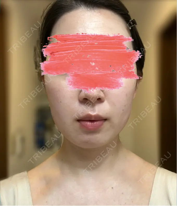 ボトックス（エラ・小顔） / 脂肪溶解注射（顔） SUNMELIA SKIN CLINIC BEFORE メイン用