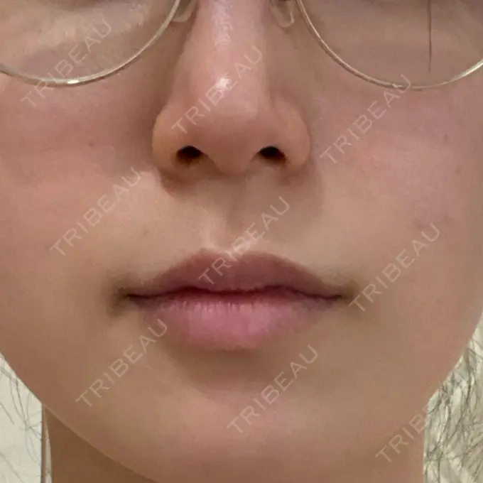 レーザートーニング（美白・肝斑） MAクリニック 心斎橋 BEFORE メイン用