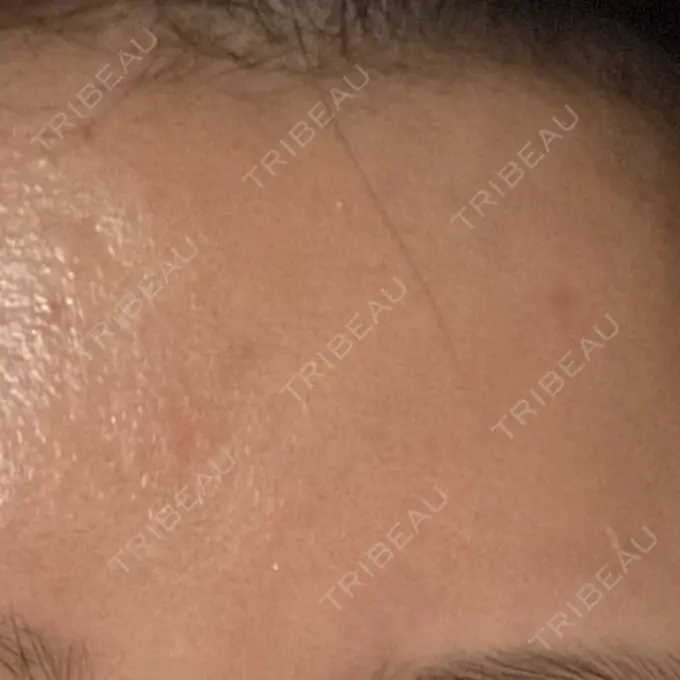 ボトックス（あご） / ボトックス（口角） / ボトックス（眉間） / ボトックス（額） TCB東京中央美容外科 静岡院 BEFORE メイン用