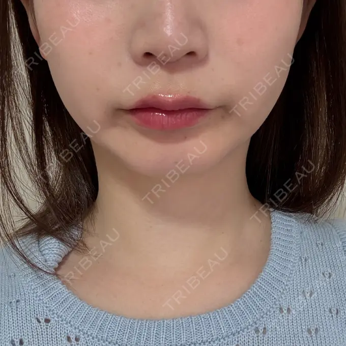 糸リフト / 脂肪吸引（顔） / 脂肪吸引（二の腕） / 脂肪吸引（脚） / 脂肪吸引（お腹） / 脂肪吸引（お尻） / 脂肪吸引（腰） / 脂肪吸引（背中） / 脂肪吸引（肩） ヴェルトラクリニック 新宿院 BEFORE メイン用