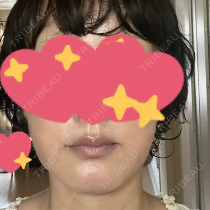 RF（高周波）たるみ治療 / その他（輪郭） DAILY SKIN CLINIC 心斎橋院 BEFORE メイン用