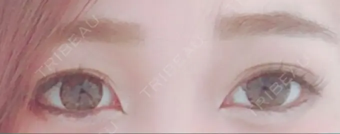 二重埋没 湘南美容クリニック 京都院 BEFORE メイン用