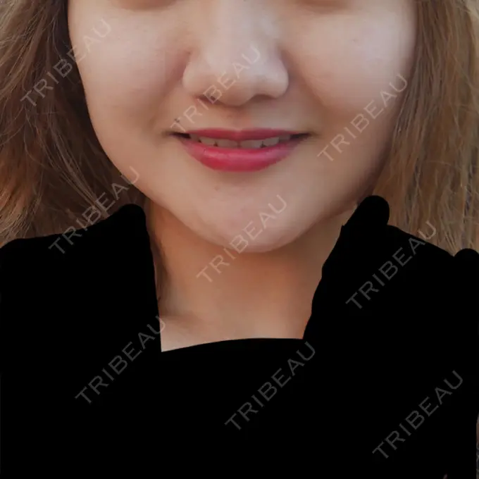 脂肪吸引（顔） アサミ美容外科 渋谷院 BEFORE メイン用