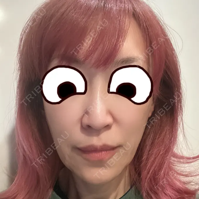 糸リフト / 下まぶたたるみ取り / 脂肪注入（目の下） / 脂肪注入（輪郭） 東京シンデレラ美容外科 池袋院 BEFORE メイン用