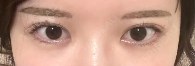 ヒアルロン酸注入（涙袋） / ヒアルロン酸注入（あご） / ボトックス（エラ・小顔） フィラークリニック 名古屋栄院 BEFORE メイン用