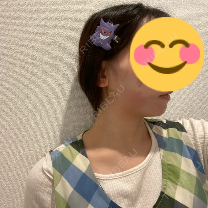 糸リフト / 脂肪吸引（顔） / ジョールファット除去 / ボトックス（エラ・小顔） RIVER CLINIC（リバークリニック） BEFORE メイン用