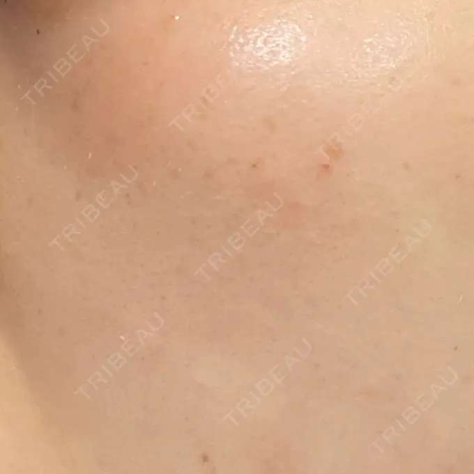 ルビーレーザー AZ BEAUTY CLINIC BEFORE メイン用