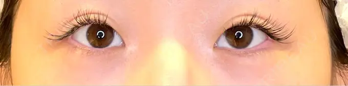 目尻切開 / タレ目形成・グラマラスライン（埋没） LOUIS CLINIC 二子玉川院【ルイクリニック】 BEFORE メイン用