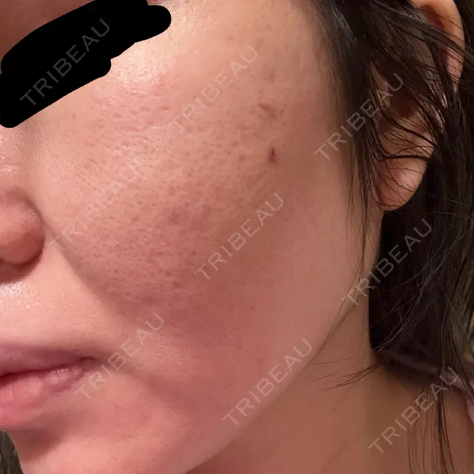 肌ヒアルロン酸注入（たるみ・シワ改善） / サブシジョン 東京シルククリニック 新宿院 BEFORE メイン用