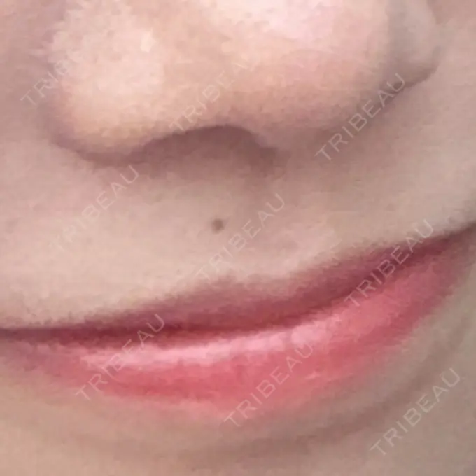 ほくろ・いぼ切除（肌） 吉祥寺アイビークリニック BEFORE メイン用