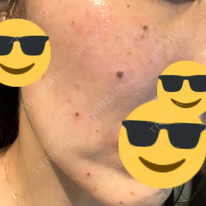 ルメッカ L‘amour clinic Tokyo【ラムールクリニック東京】 BEFORE メイン用