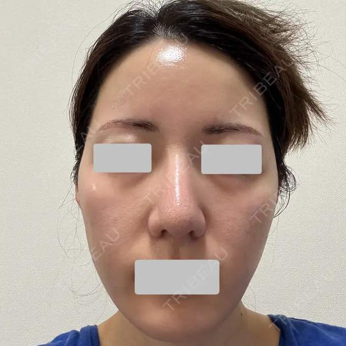 肌育注射（ジュベルックなど） Next Tokyo Clinic BEFORE メイン用