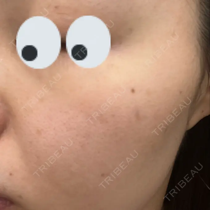 毛穴洗浄（ハイドラフェイシャルなど） / ピコレーザートーニング（美白・肝斑） アーククリニック BEFORE メイン用