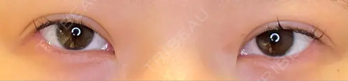 目尻切開 / タレ目形成・グラマラスライン（埋没） LOUIS CLINIC 二子玉川院【ルイクリニック】 BEFORE メイン用