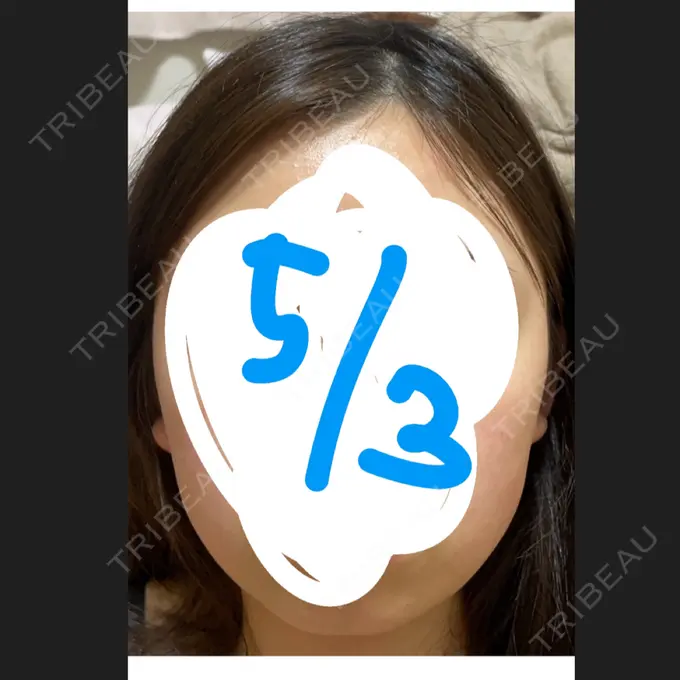 ボトックス（あご） / ヒアルロン酸注入（あご） 銀座TAクリニック BEFORE メイン用