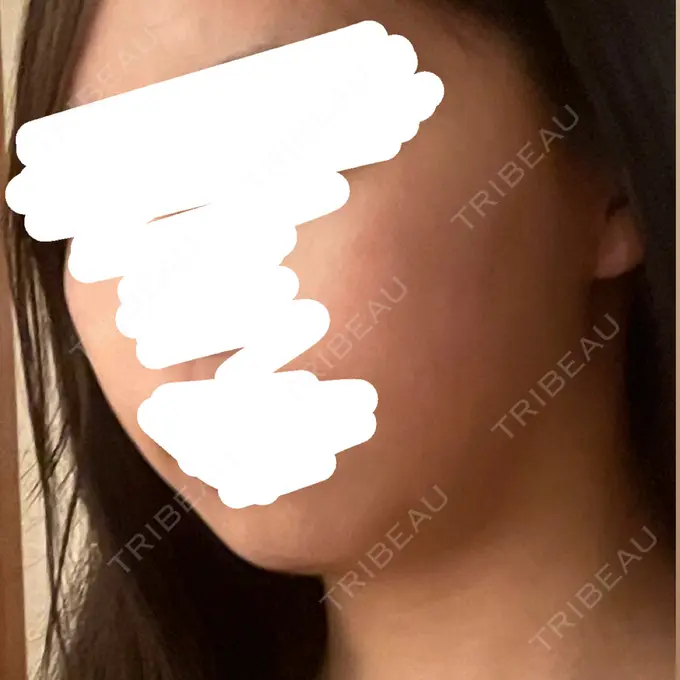 ハイフ（顔） DAILY SKIN CLINIC 新宿院 BEFORE メイン用